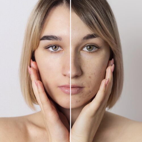 eliminar manchas cara con peelings