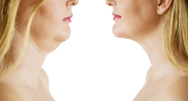diatermia facial elimina papada