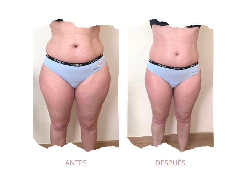 tratamientos corporales reductores para el verano. Bioslimming funciona