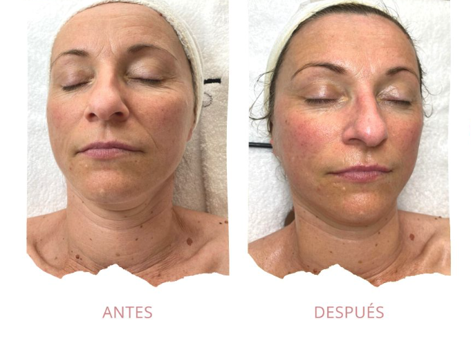 tratamiento facial detox