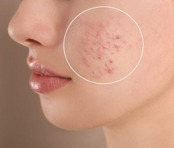 peeling facial para acné